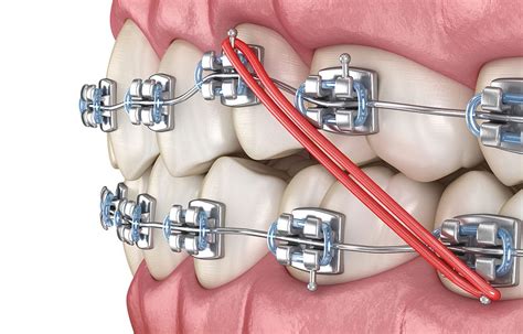 Answer To The Issue Of A Broken Bracket Calismile Orthodontics