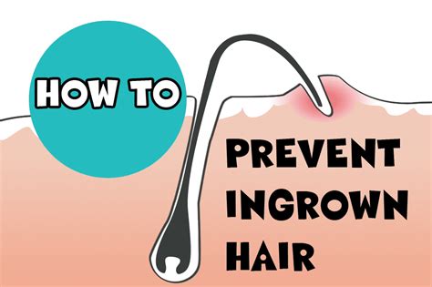 How To Fix Ingrown Hair In Armpit Persistent Ingrown Hairs When