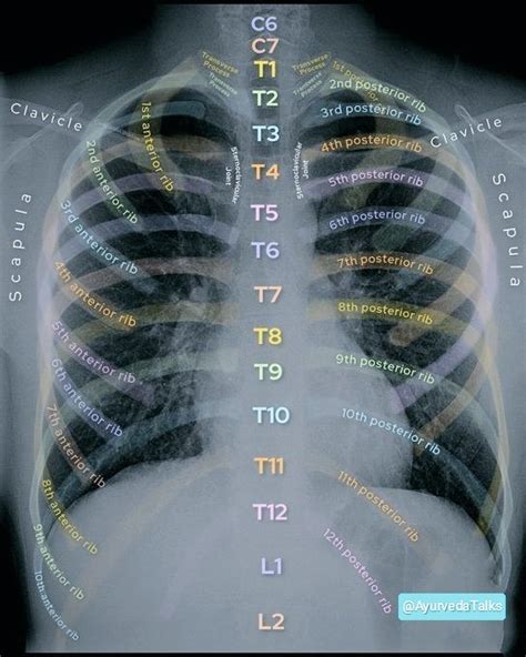 𝖠𝗒𝗎𝗋𝗏𝖾𝖽𝖺 𝖳𝖺𝗅𝗄𝗌 on Twitter Normal Chest X Ray Anatomy AP View and PA View