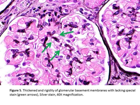 Kidney Biopsy Of The Month Membranous Nephropathy Renal Fellow Network