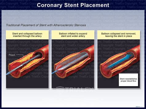 Coronary Stent Placement Trialexhibits Inc