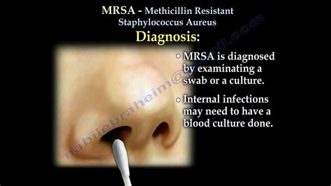 Staphylococcus Aureus Infection In Nose