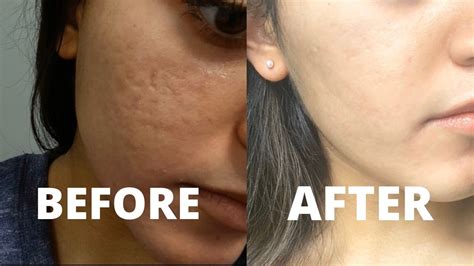 My Co2 Laser Resurfacing Treatment Experience How To Get Rid Of Acne