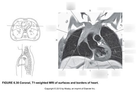 Coronal T1 Weighted Mri Of Surfaces And Borders Of Heart Diagram