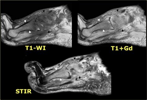 Mri Musculo Skeletal Section Acute Versus Chronic Charcot