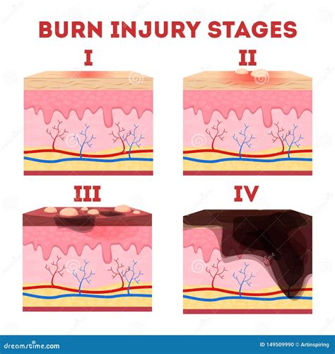Skin Burn Three Degrees Of Burns Type Of Injury Vecto