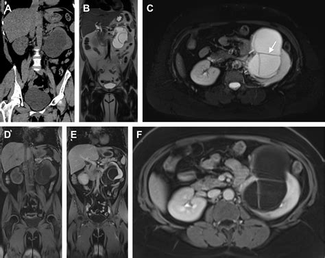 Classification And Diagnosis Of Cystic Renal Tumors Magnetic