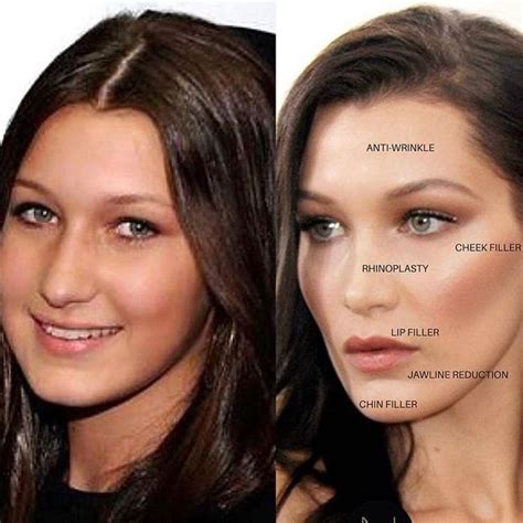 Should you get brow botox? #celebrities in 2020 | Botox brow lift, Botox, Facial fillers