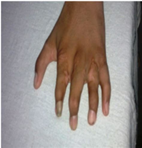 Poland syndrome is a rare condition that is evident at birth (congenital). A 13 year old boy with Poland syndrome having asymmetrical ...