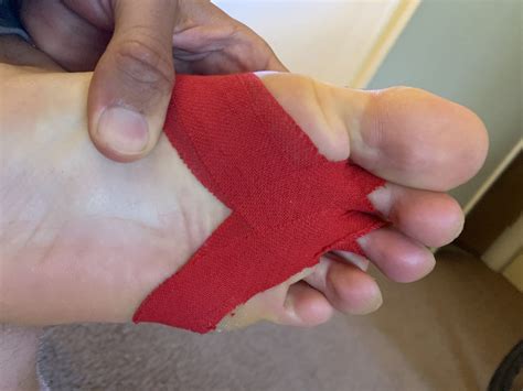 How To Tape Toes For Plantar Plate Tear Plantar Health