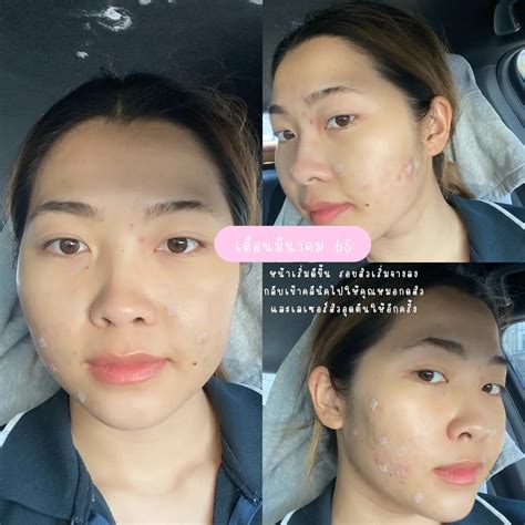 รีวิว Skincare ที่ใช้รักษาในช่วงสิวเห่อจนมาถึงปัจจุบัน 🥹 แกลเลอรีที่