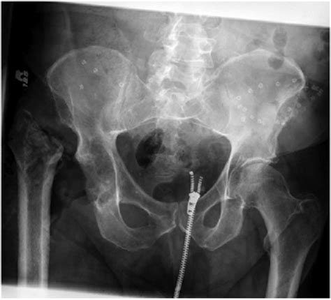 Ap Pelvis Radiograph After Implant Resection For Late Hematogenous