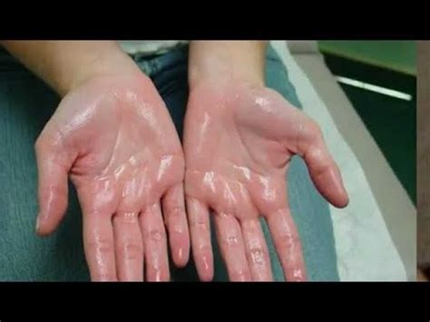How To Cure Hyperhidrosis Stop Excessive Sweating In Hands Armpits