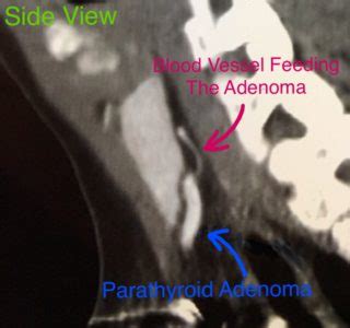 Ct Scan Image Parathyroid Adenoma Hyperparathyroidism Surgery Dr