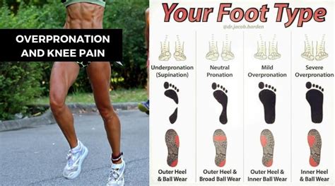 Overpronation And Knee Pain Causes And Prevention Runnerguru