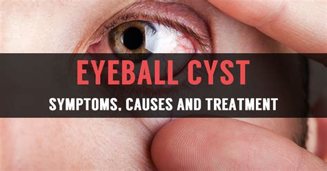 Learn Reasons For Eyeball Cyst And Its Treatment