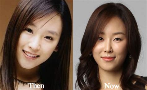 Seo Hyun Jin Plastic Surgery Rumors Before And After Photos Latest