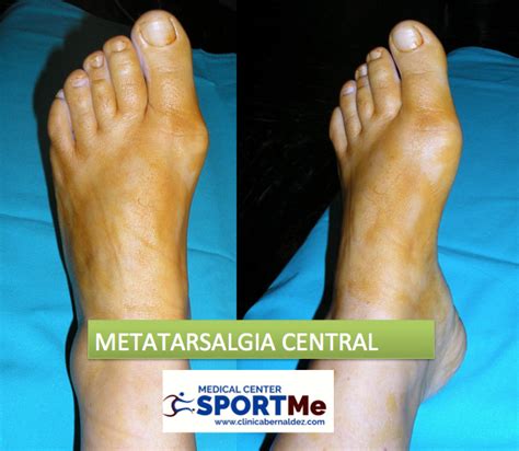 Metatarsalgia Diagnóstico Y Tratamiento Sportme Sevilla