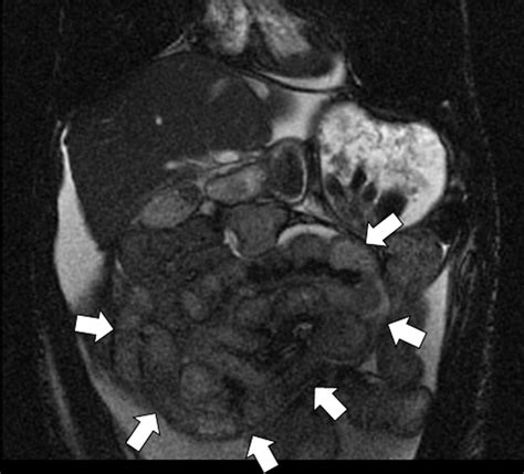 Encapsulating Peritoneal Sclerosis The Abdominal Cocoon Radiographics