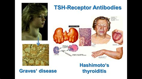 Tsh Receptor Antibodies Nomenclature Functionality And Assay