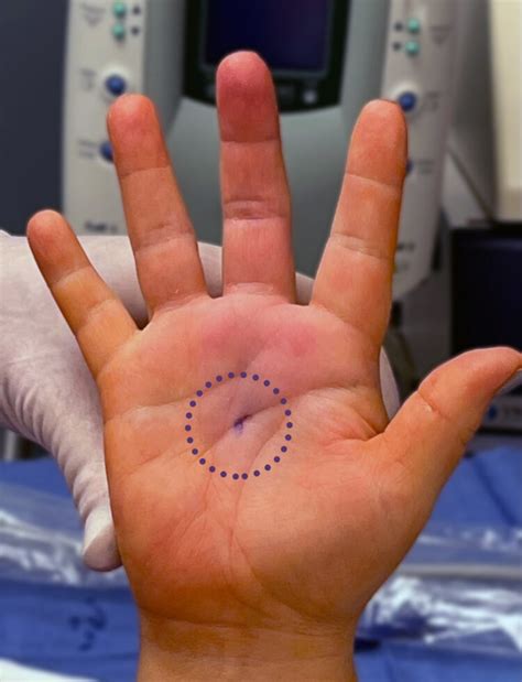 Trigger Finger Release With Ultrasound Guidance Sonex Health
