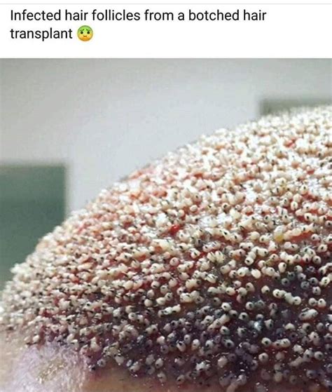 Infected Hair Follicles From A Botched Hair Transplant Ifunny