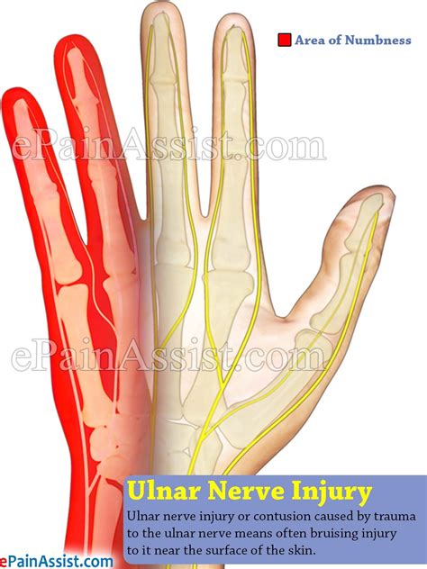 Ulnar Nerve Injury Ulnar Nerve Ulnar Nerve Entrapment Nerve Entrapment