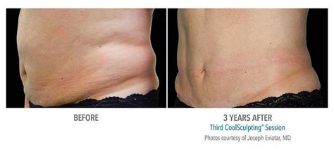 Coolsculpting And Dualsculpting Bend Or Stubborn Fat Removal