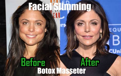 Facial Slimming With Botox Charmed Medispa