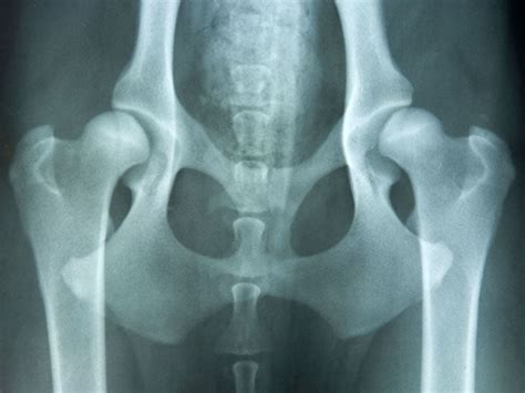 Congenital Hip Dislocation Causes Symptoms And Diagnosis