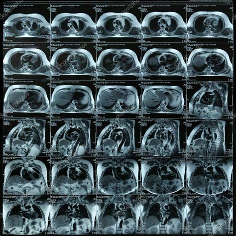 Chest Mri Stock Photo By ©beerkoff1 6335116