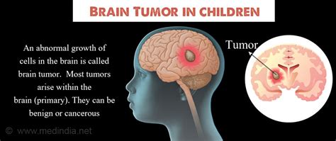 In the uk, the median symptom interval (time a child in whom cns imaging is required to exclude a brain tumour (potential diagnosis but low index of suspicion) should be imaged within 4 weeks. Brain Tumor in Children - Types, Causes, Symptoms ...