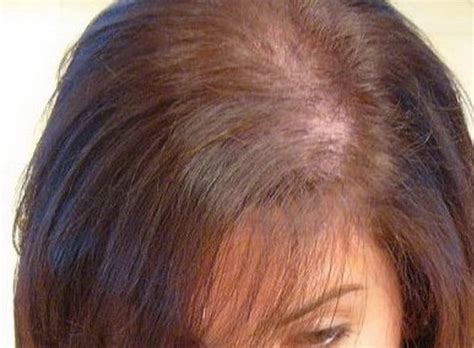 The drug lowers the production of dihydrotestosterone, a male hormone blamed for hair loss. Home Remedies And Treatment Options For Heavy Hair Loss ...