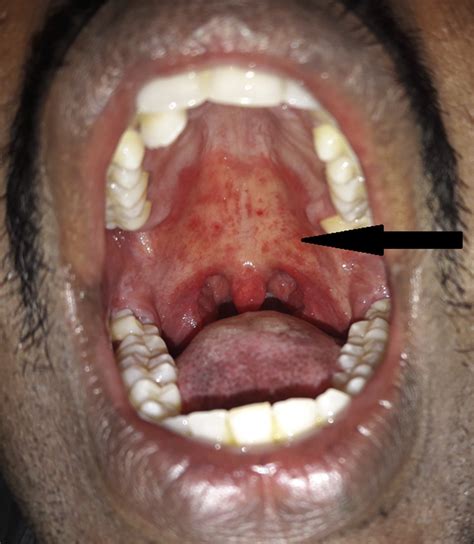 Erythematous Candidiasis The Journal Of Allergy And Clinical