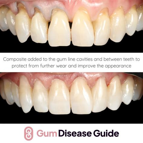 Using Composite Fillings For Gum Recession Gum Disease Guide