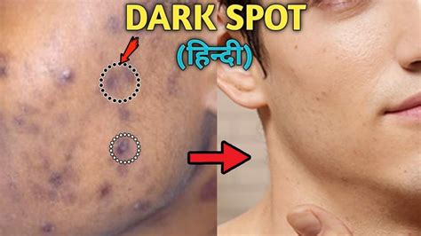 How To Remove Dark Spots From Face Naturally Acne Scars Black Spots