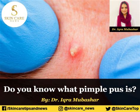Do You Know What Pimple Pus Is Skin Care Top News