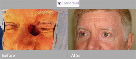Eyelid Skin Cancer Before And After Photos Taban Md