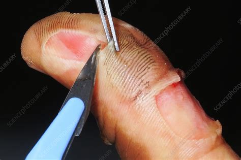 Excision Of A Blister Caused By A 2nd Degree Burn Stock Image C050