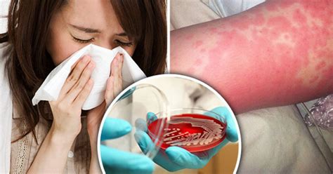scarlet fever outbreak uk seven symptoms you should never ignore daily star