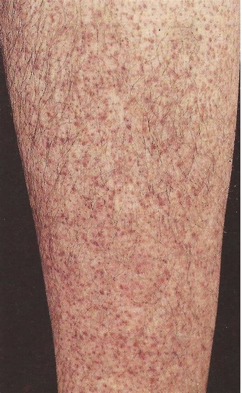 Moretones en las piernas causas y síntomas