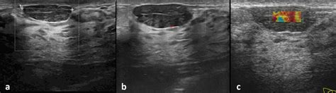 A Ultrasound Image Of Retroareolar Mass Of The Same Patient B