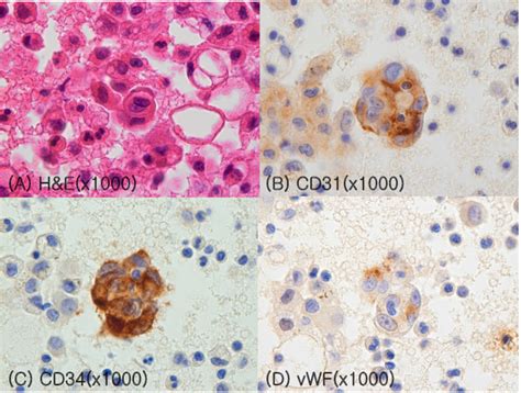 Pathological Findings Of Pleural Fluid Cytology A Hande Staining