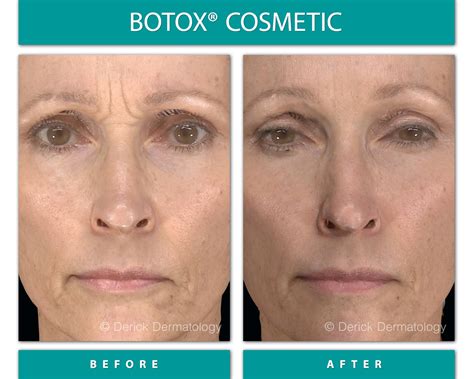 Before And After Gallery Botox Derick Dermatology