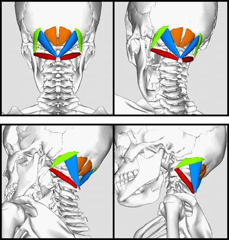 Suboccipital Muscles And Cervicogenic Headache Ms Physiotherapy