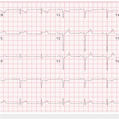 Electrocardiogram Ekg Showing St Segments Elevation In Leads I And