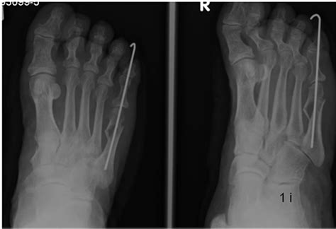 Metatarsal Fracture Reduction And Fixation By Kirschner Wires