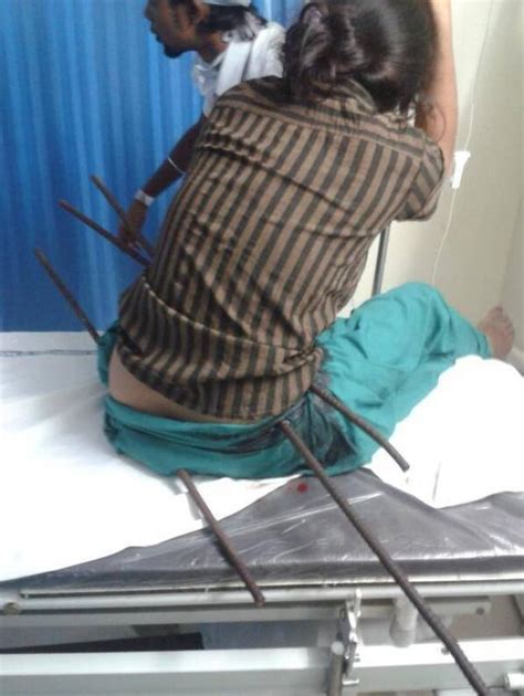 Girl Is Impaled On Three Metal Rodsand Survives Metro News