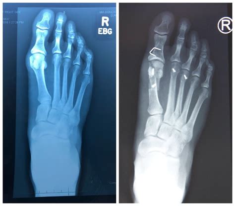 Bunion Surgery Update 6 Weeks Post Operation — Inside Out Style
