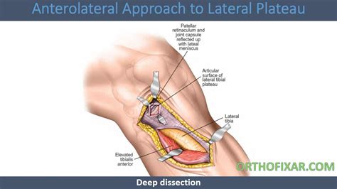 Anterolateral Approach To Lateral Plateau 2023 Orthofixar